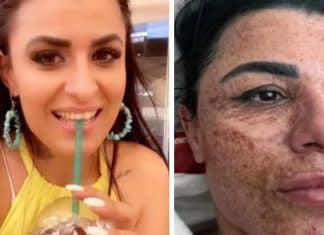 Mulher tem rosto queimado após esteticista distrair-se com celular