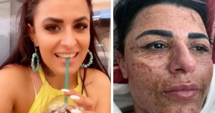 Mulher tem rosto queimado após esteticista distrair-se com celular