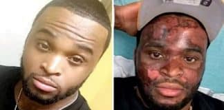 Influenciador fica com rosto queimado após se submeter a tratamento de peeling químico