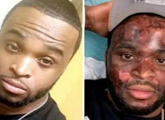 Influenciador fica com rosto queimado após se submeter a tratamento de peeling químico