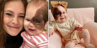 Mãe de bebezinha com marca de nascença rara no rosto mostra à filha que ela é linda
