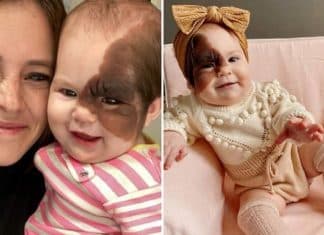 Mãe de bebezinha com marca de nascença rara no rosto mostra à filha que ela é linda