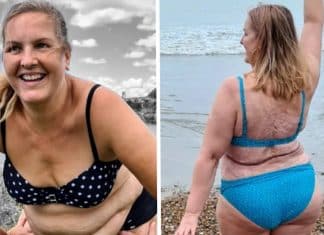 Mulher mostra suas queimaduras nas redes sociais para incentivar o amor próprio.