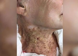 Estudo analisa pele de idosa que passou 40 anos usando filtro solar só no rosto