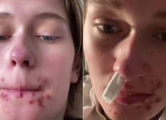 Após dar primeiro beijo em um ano, jovem desenvolve herpes grave