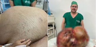 Mulher que removeu tumor de 46 kg falece 11 dias após cirurgia