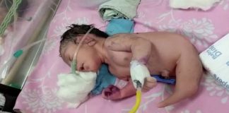 Nascimento de ‘bebê-sereia’ na Índia atrai multidão a maternidade