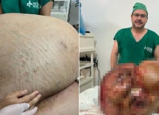 Mulher que removeu tumor de 46 kg falece 11 dias após cirurgia