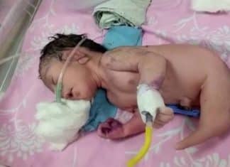 Nascimento de ‘bebê-sereia’ na Índia atrai multidão a maternidade