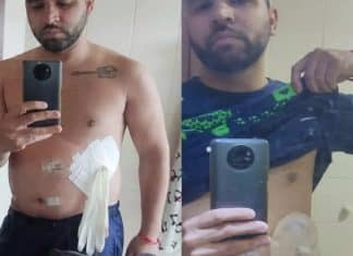 Médico é demitido após improvisar bolsa de colostomia com luva cirúrgica no PR