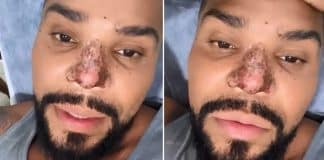 Naldo sofre necrose no nariz depois de procedimento estético: “Muito preocupado” Naldo sofre necrose no nariz depois de procedimento estético: “Muito preocupado”