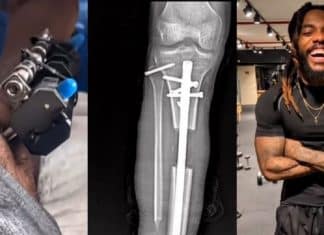 Tiktoker “cresceu” 17cm se submetendo a cirurgias assustadoras e dolorosas