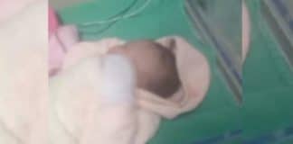 Bebê que teve a cabeça cortada no parto pode ter sequela neurológica permanente