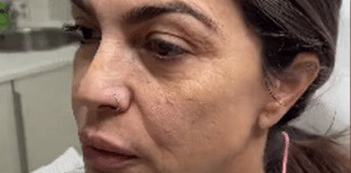 Mulher impressiona com antes e depois de harmonização facial: “Vai ter que tirar nova identidade”