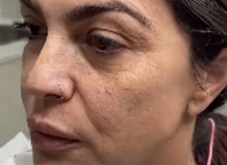 Mulher impressiona com antes e depois de harmonização facial: “Vai ter que tirar nova identidade”