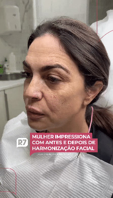 contioutra.com - Mulher impressiona com antes e depois de harmoniza&ccedil;&atilde;o facial: "Vai ter que tirar nova identidade"