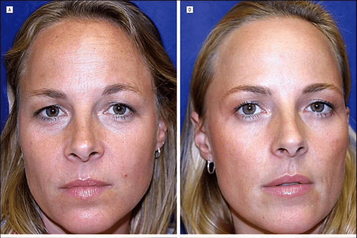 contioutra.com - Estudo com g&ecirc;meas testa efic&aacute;cia do botox; uma fez aplica&ccedil;&otilde;es por 19 anos, outra n&atilde;o