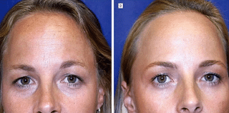 Estudo com gêmeas testa eficácia do botox; uma fez aplicações por 19 anos, outra não