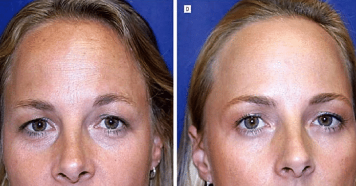 Estudo com gêmeas testa eficácia do botox; uma fez aplicações por 19 anos, outra não