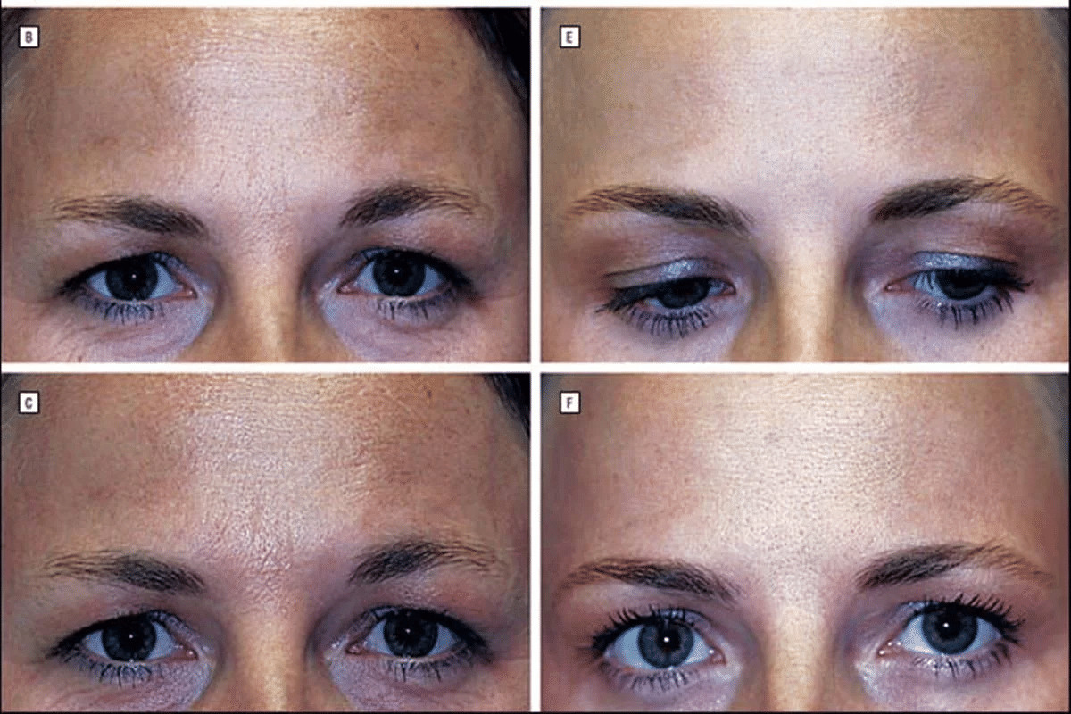 contioutra.com - Estudo com g&ecirc;meas testa efic&aacute;cia do botox; uma fez aplica&ccedil;&otilde;es por 19 anos, outra n&atilde;o