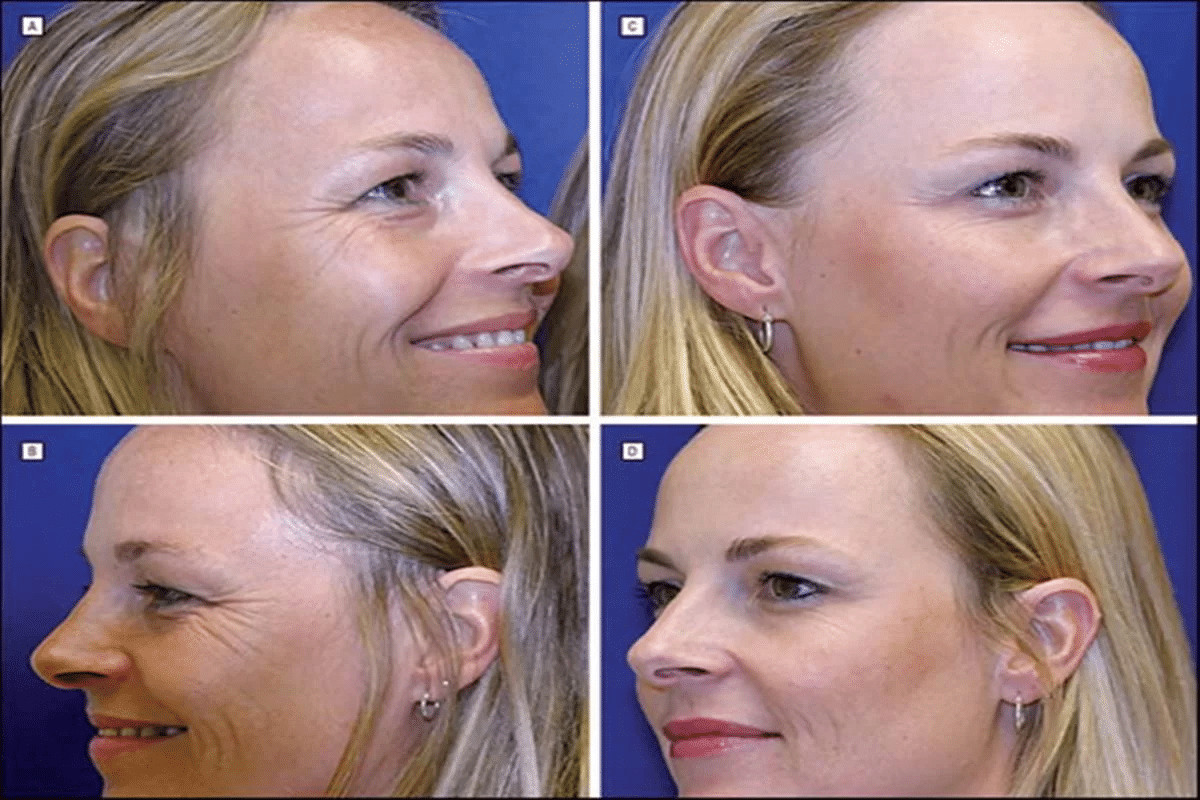 contioutra.com - Estudo com g&ecirc;meas testa efic&aacute;cia do botox; uma fez aplica&ccedil;&otilde;es por 19 anos, outra n&atilde;o