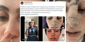 Jovem incomodada com sinal no nariz descobre câncer raro. Saiba mais!