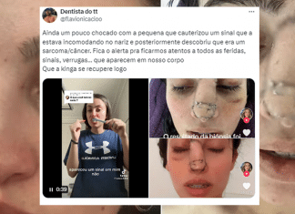 Jovem incomodada com sinal no nariz descobre câncer raro. Saiba mais!
