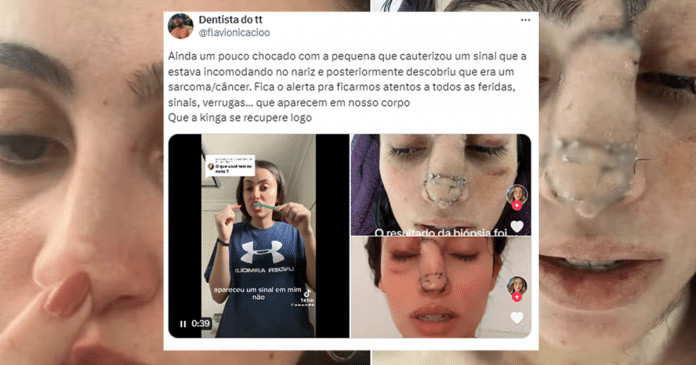 Jovem incomodada com sinal no nariz descobre câncer raro. Saiba mais!