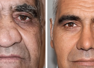 Homem surpreende a web com transformação após procedimentos estéticos: “Outra pessoa.”