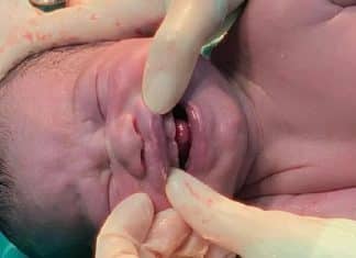 Vídeo: Bebê nasce com seis dentinhos e surpreende equipe médica no Mato Grosso do Sul