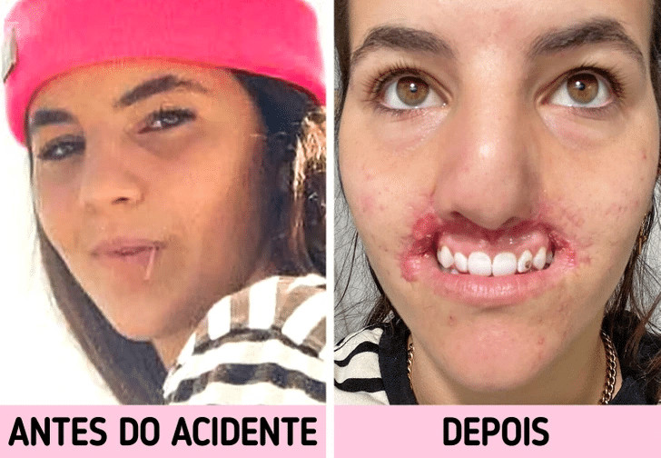 contioutra.com - Jovem que perdeu os l&aacute;bios ap&oacute;s ataque de pitbull compartilha sua jornada de recupera&ccedil;&atilde;o