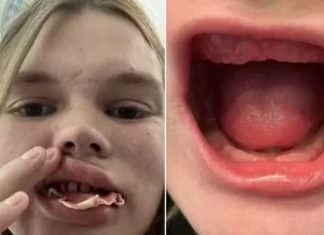 Tratamento dentário barato faz mulher perder todos os dentes; saiba o que aconteceu!