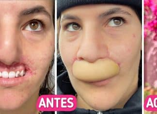 Jovem que perdeu os lábios após ataque de pitbull compartilha sua jornada de recuperação