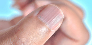 O que significa ter linhas verticais nas unhas?
