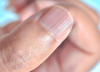 O que significa ter linhas verticais nas unhas?