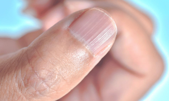 O que significa ter linhas verticais nas unhas?