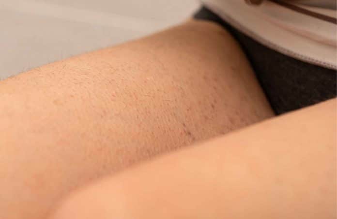 Design sem nome (36) Foliculite na virilha: o que é e como surge