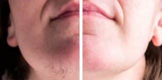 Saiba o que significa ter pelos crescendo no queixo (e quando se preocupar) Saiba o que significa ter pelos crescendo no queixo (e quando se preocupar)