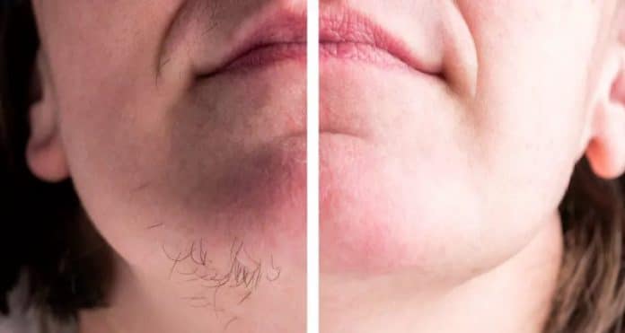 Saiba o que significa ter pelos crescendo no queixo (e quando se preocupar)