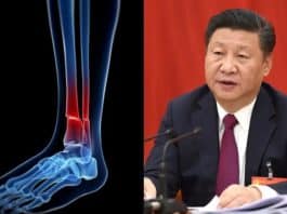 A China inventou uma nova 'cola para ossos' que repara fraturas em 3 minutos, sem necessidade de cirurgia ou placas de metal