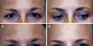 Gêmeas idênticas após 20 anos: uma usou botox, a outra não — resultado divide opiniões