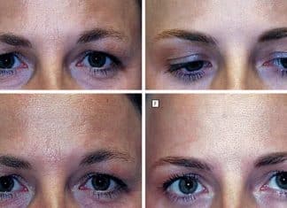 Gêmeas idênticas após 20 anos: uma usou botox, a outra não — resultado divide opiniões