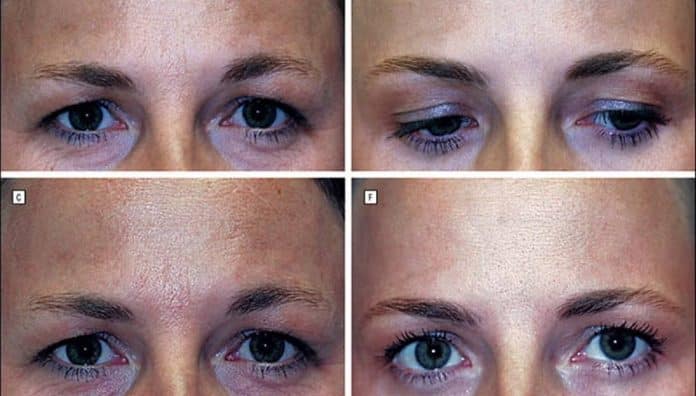 Gêmeas idênticas após 20 anos: uma usou botox, a outra não — resultado divide opiniões