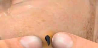 Simulação mostra por que espremer cravos é o pior erro que você pode cometer com a pele