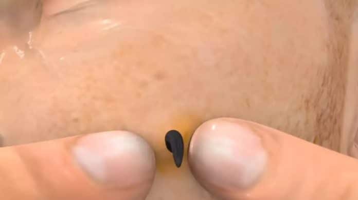 Simulação mostra por que espremer cravos é o pior erro que você pode cometer com a pele