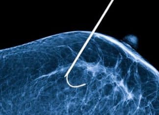 Nova técnica criada no Brasil contra o câncer de mama, que congela tumor com nitrogênio líquido, atinge 100% de eficácia