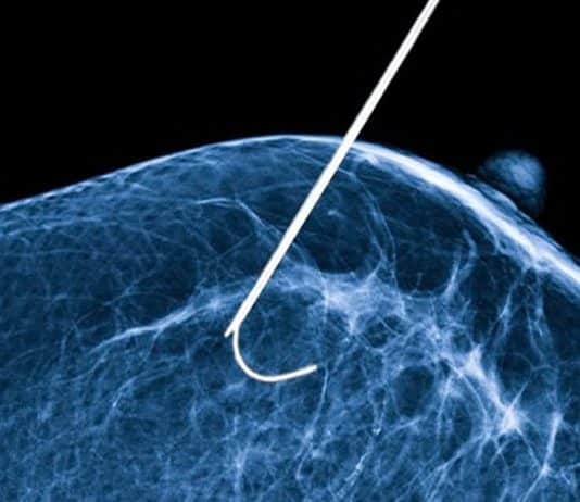 Nova técnica criada no Brasil contra o câncer de mama, que congela tumor com nitrogênio líquido, atinge 100% de eficácia novo tratamento cancer de mama com nitrogenio liquido