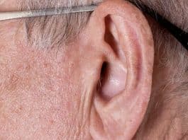 Este sinal na orelha é risco de infarto