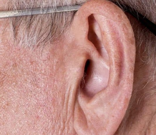 Este sinal na orelha é risco de infarto