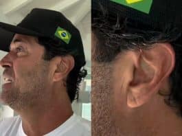 sinal de frank na orelha